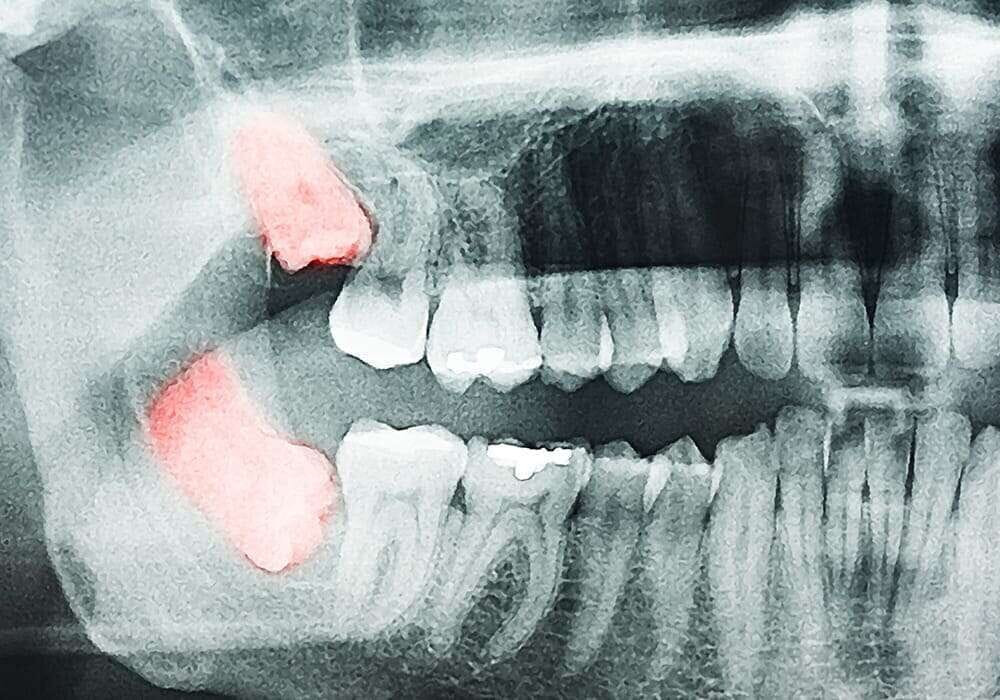 Denti del giudizio inclusi, storti e orizzontali